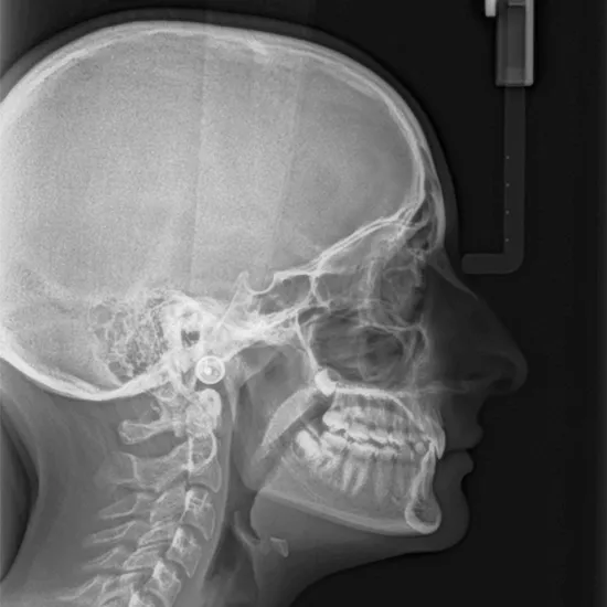 X-Ray Skull Lateral View Procedure